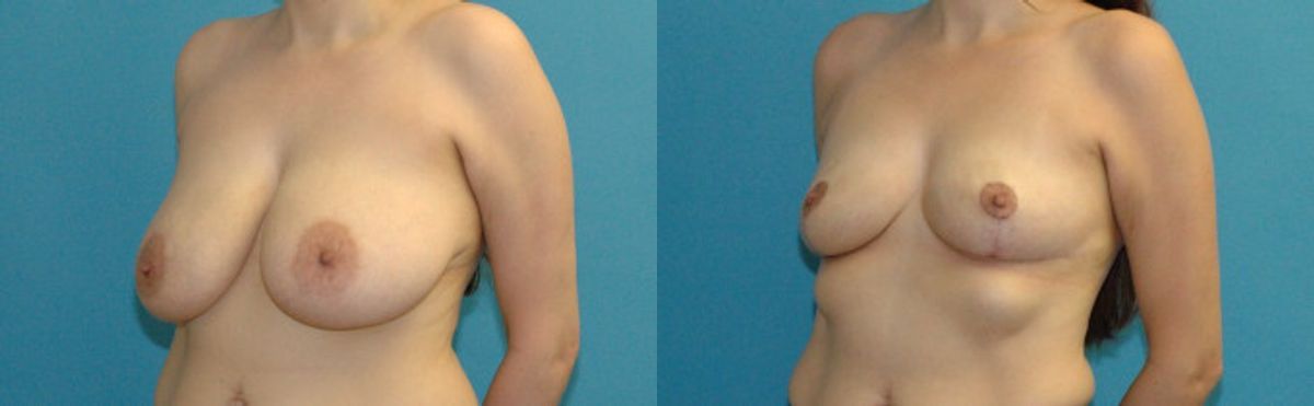 Breast Reduction #36 - Before and After