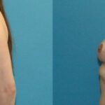 Breast Reduction #36 - Before and After