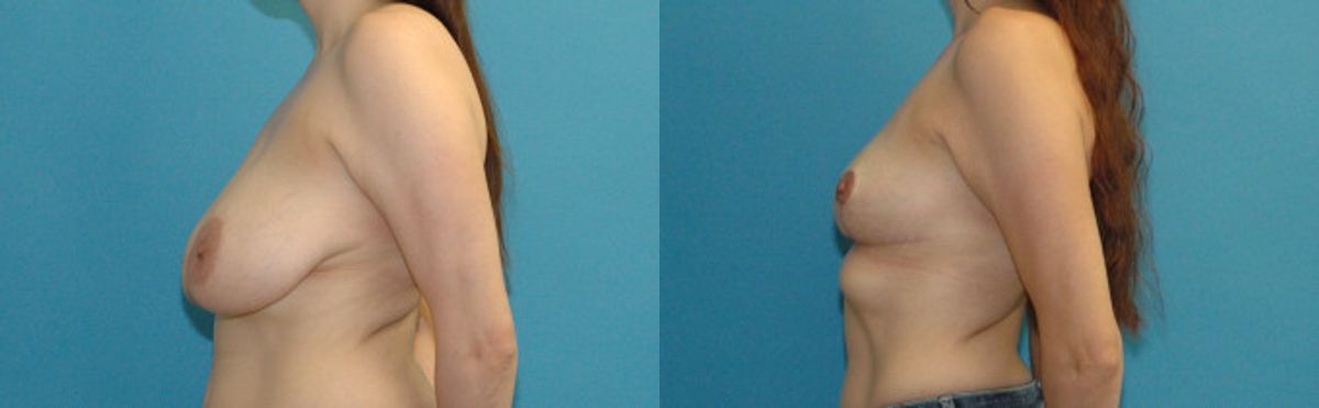 Breast Reduction #36 - Before and After