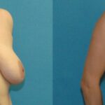 Breast Reduction #36 - Before and After