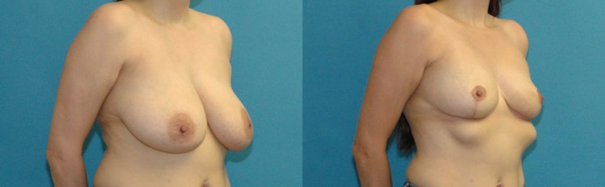 Breast Reduction #36 - Before and After