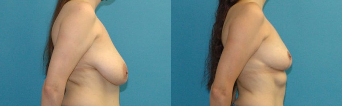 Breast Reduction #36 - Before and After