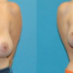 Breast Reduction #37 - Before and After