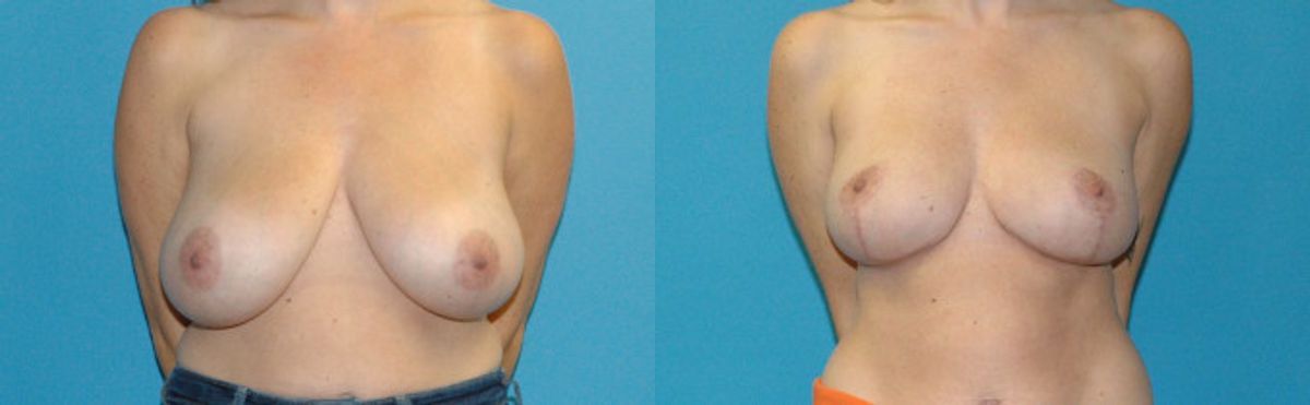 Breast Reduction #37 - Before and After