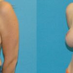 Breast Reduction #37 - Before and After