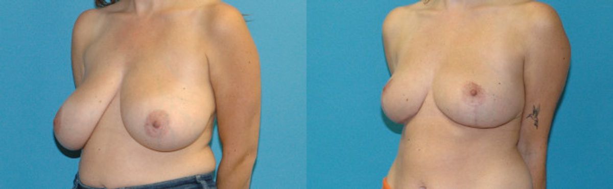 Breast Reduction #37 - Before and After