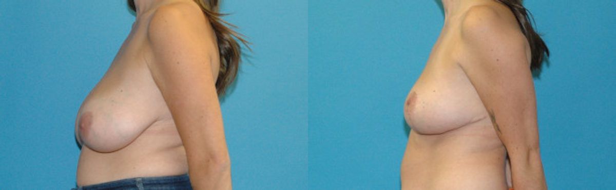 Breast Reduction #37 - Before and After