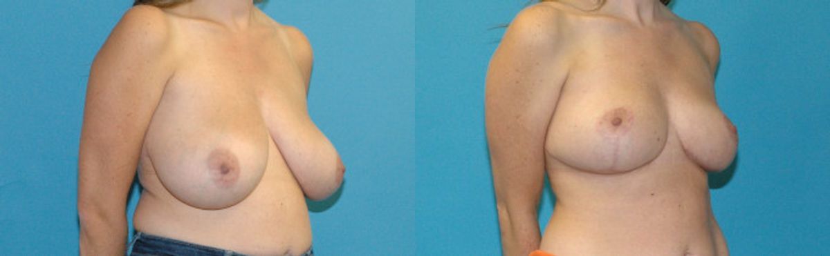 Breast Reduction #37 - Before and After