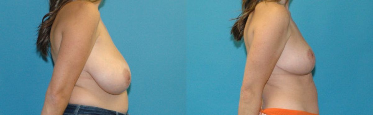 Breast Reduction #37 - Before and After