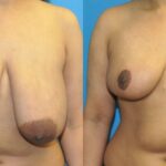 Breast Reduction #38 - Before and After