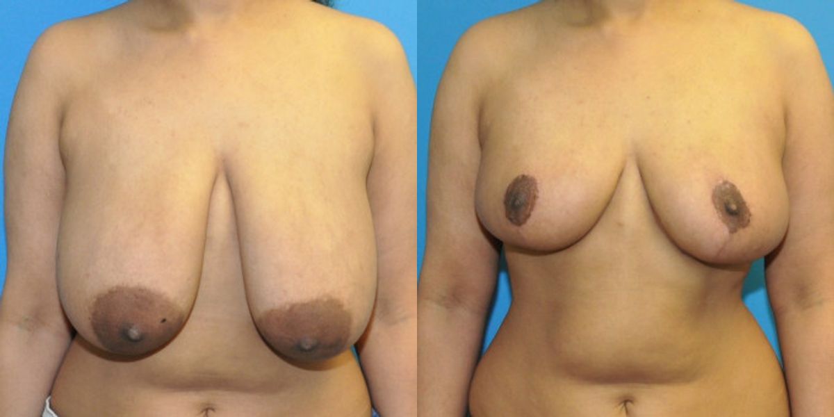 Breast Reduction #38 - Before and After
