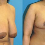 Breast Reduction #38 - Before and After