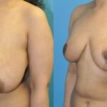 Breast Reduction #38 - Before and After