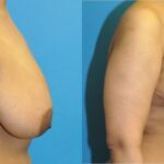 Breast Reduction #38 - Before and After