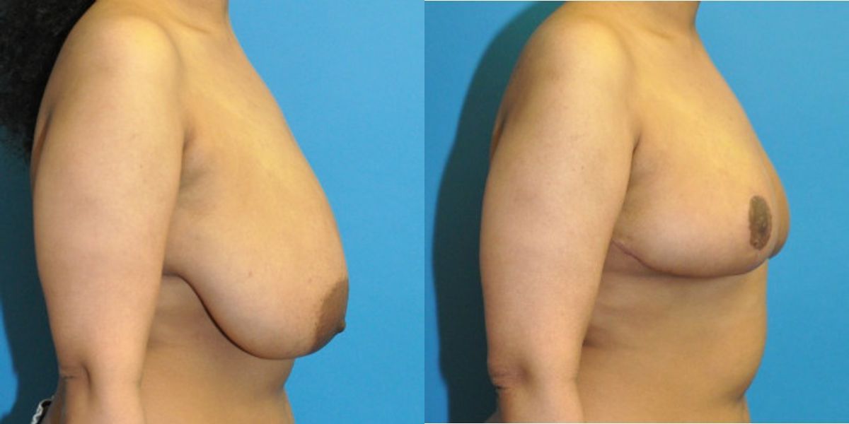 Breast Reduction #38 - Before and After