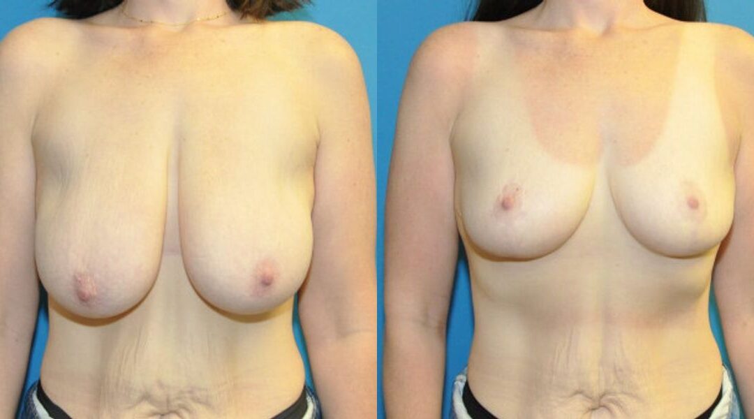 Breast Reduction #39