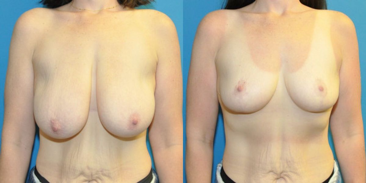 Breast Reduction #39 - Before and After
