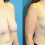 Breast Reduction #39 - Before and After