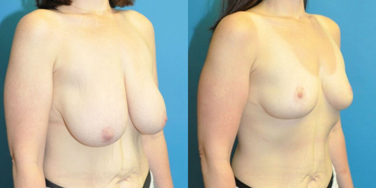 Breast Reduction #39 - Before and After