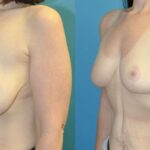 Breast Reduction #39 - Before and After