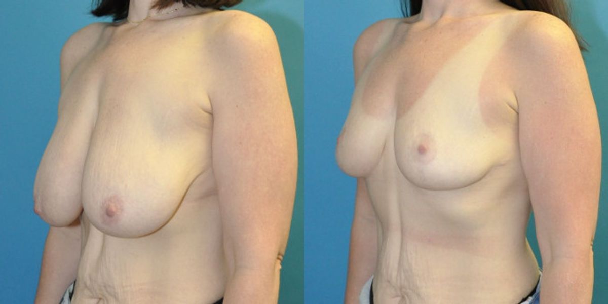 Breast Reduction #39 - Before and After