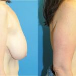 Breast Reduction #39 - Before and After