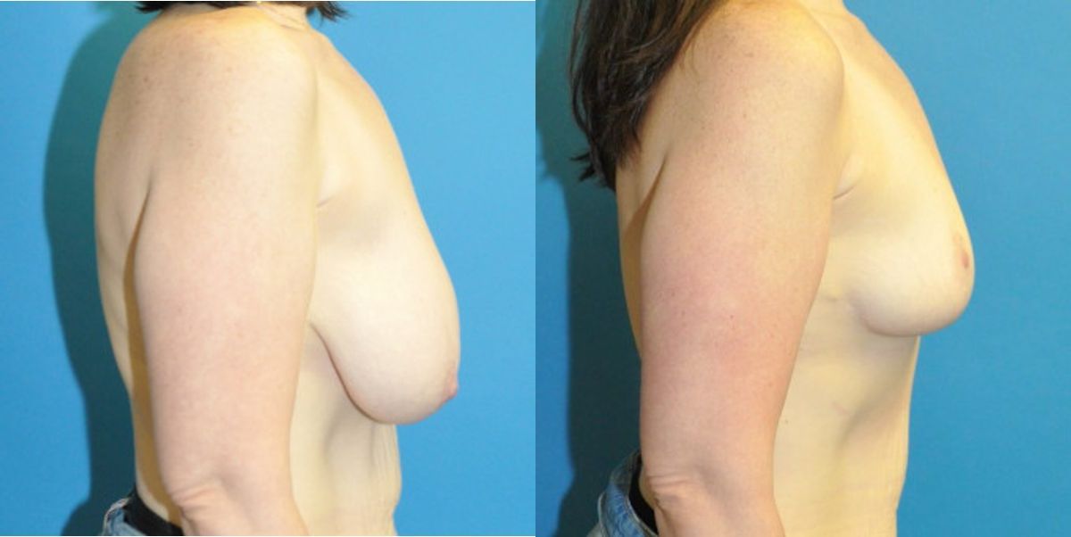 Breast Reduction #39 - Before and After