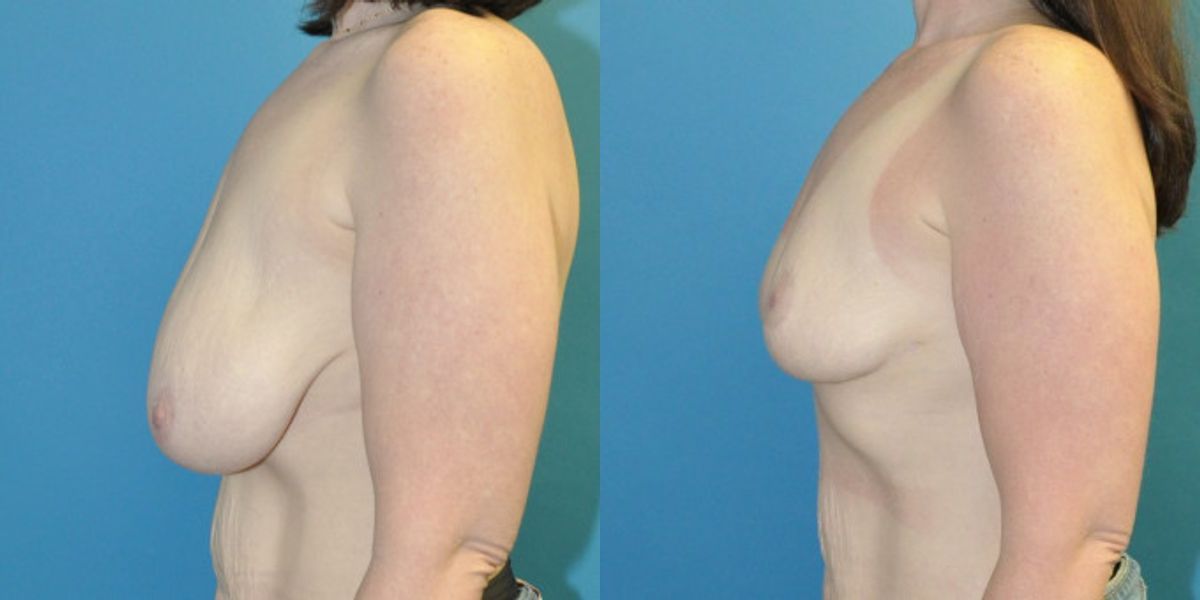 Breast Reduction #39 - Before and After