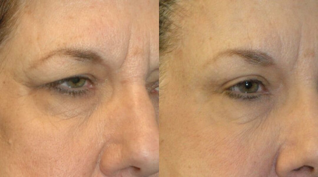 Browlift, Blepharoplasty (Eyelid Lift) and Fat Grafting