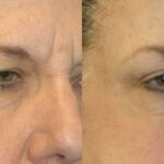 Browlift, Blepharoplasty (Eyelid Lift) and Fat Grafting - Before and After