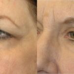 Browlift, Blepharoplasty (Eyelid Lift) and Fat Grafting - Before and After