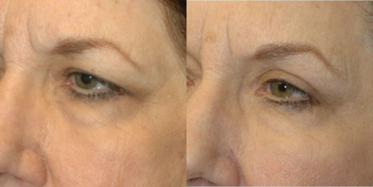 Browlift, Blepharoplasty (Eyelid Lift) and Fat Grafting - Before and After