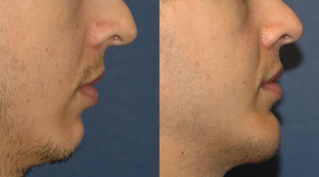 Chin Implant #1