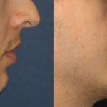 Chin Implant #1 - Before and After