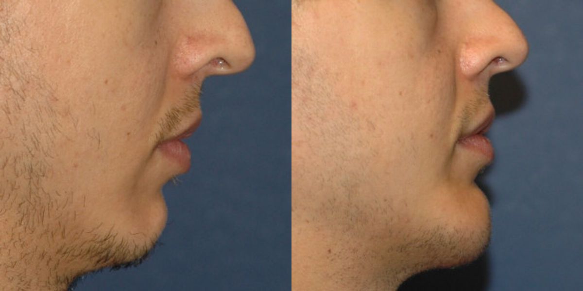 Chin Implant #1 - Before and After