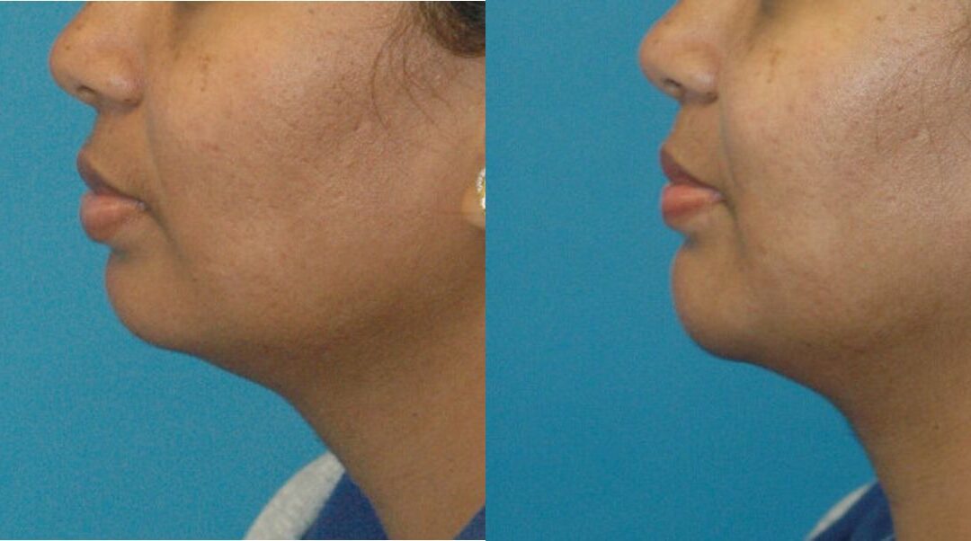 Chin Implant #2