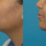 Chin Implant #2 - Before and After