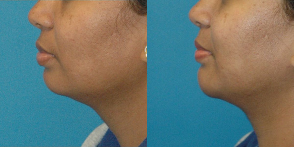 Chin Implant #2 - Before and After