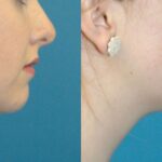 Chin Implant #3 - Before and After