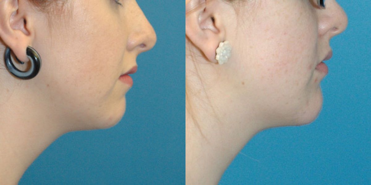 Chin Implant #3 - Before and After