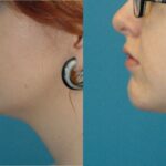 Chin Implant #3 - Before and After