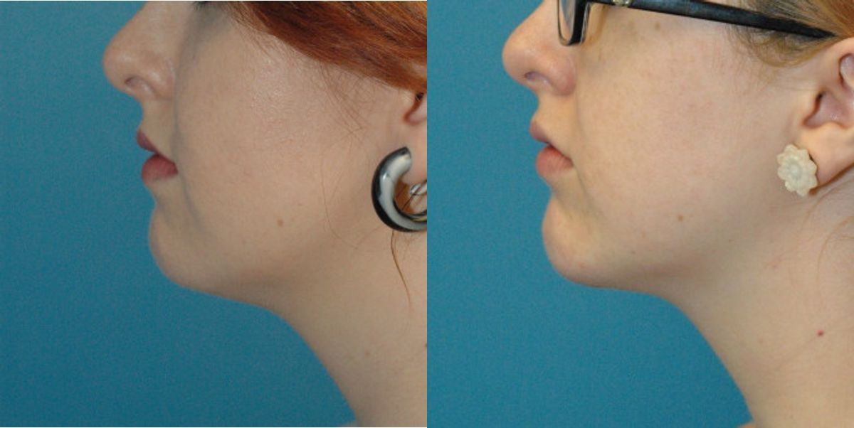 Chin Implant #3 - Before and After