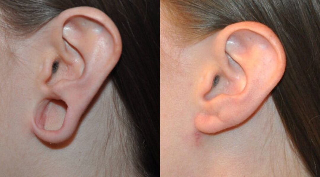 Earlobe Repair #1