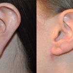 Earlobe Repair #1 - Before and After