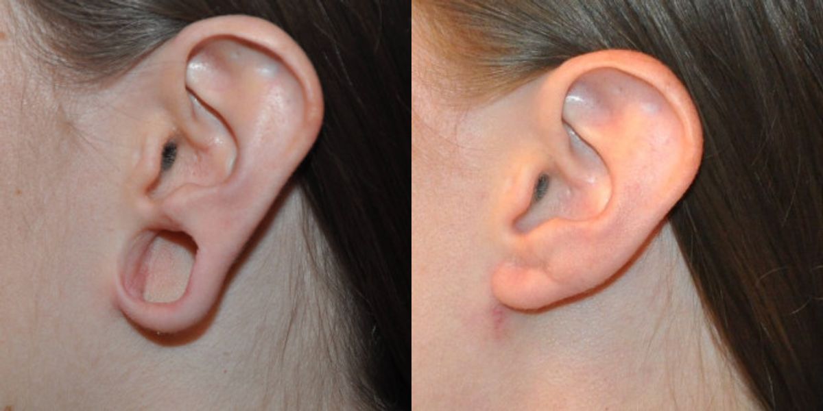 Earlobe Repair #1 - Before and After