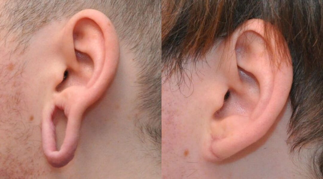 Earlobe Repair #2