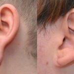 Earlobe Repair #2 - Before and After
