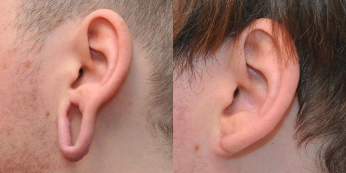 Earlobe Repair #2 - Before and After