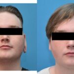 Earlobe Repair #2 - Before and After