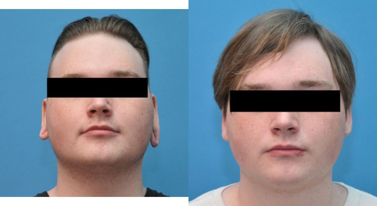 Earlobe Repair #2 - Before and After